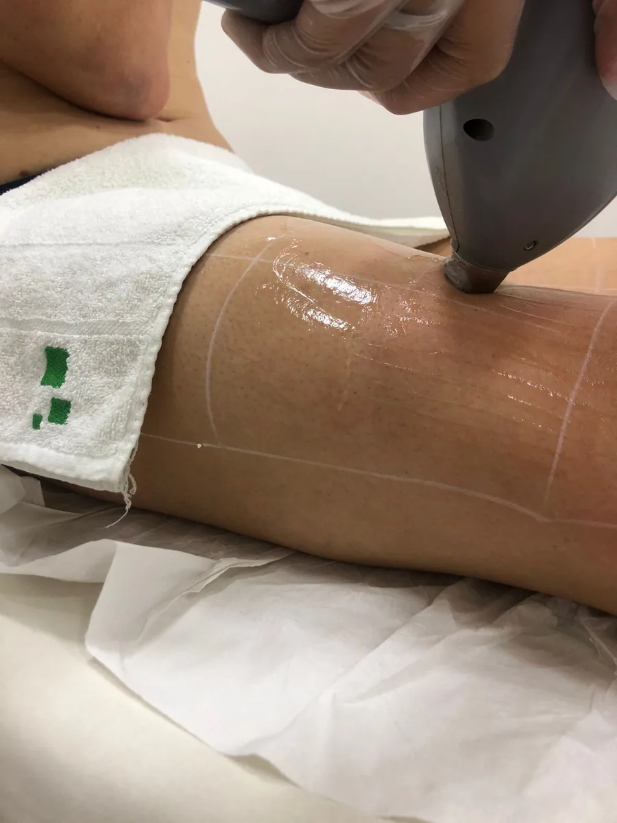 Sessão real de depilação a laser na perna, aplicada por profissional da Nova Fitlaser